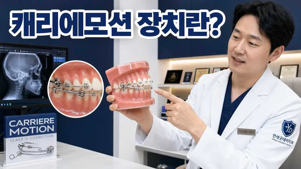 캐리에모션 장치가 뭔가요? 언제 사용하나요 | 전문의