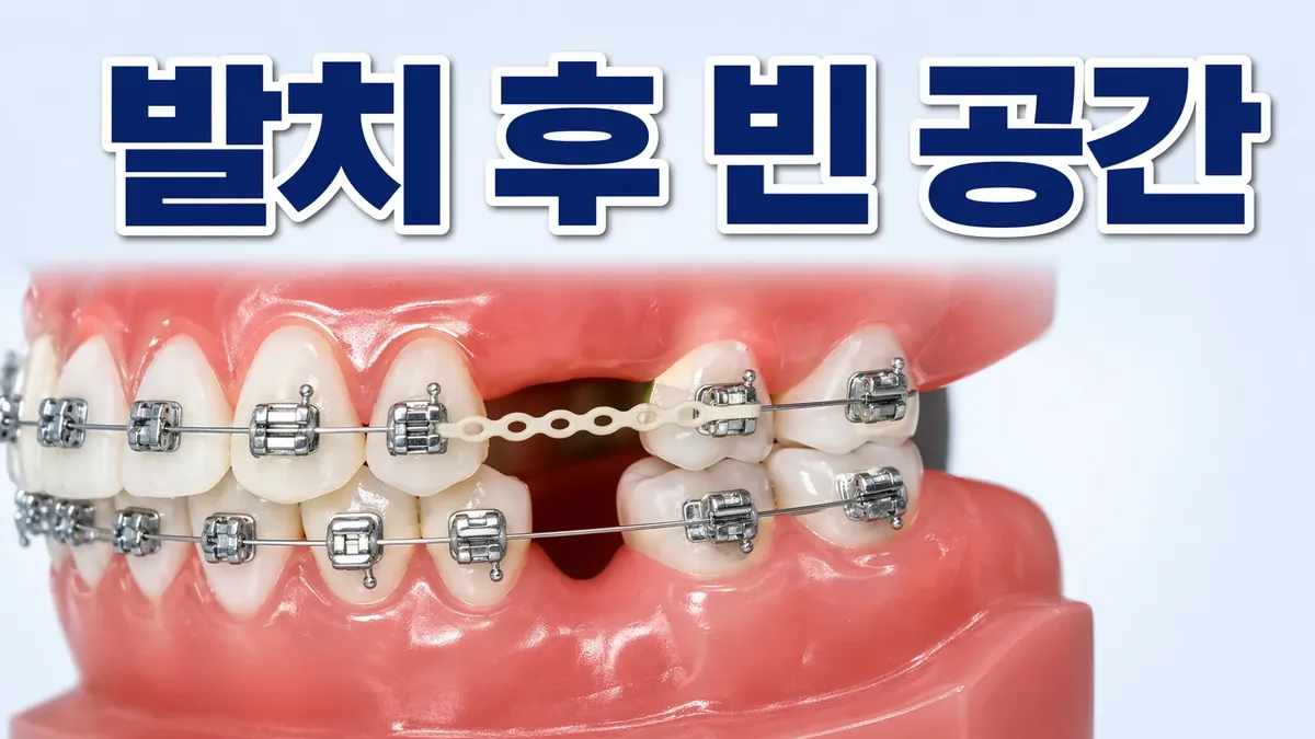 교정 발치 후 빈 공간 언제 닫히나요? 기간과 과정