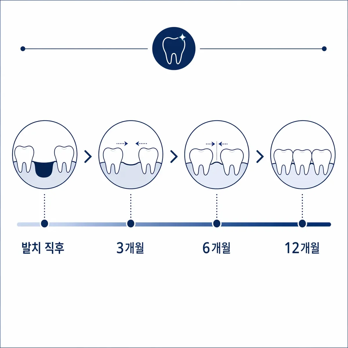 발치 공간 닫히는 타임라인