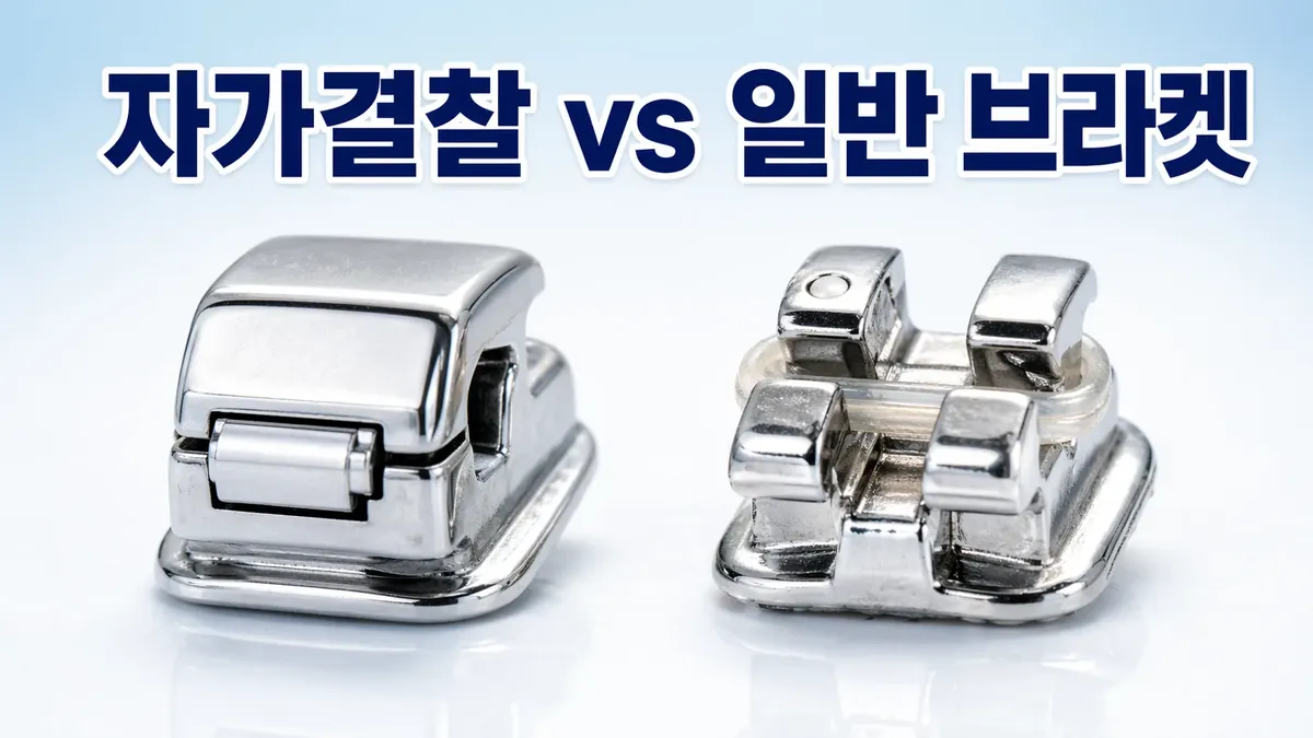 자가결찰 브라켓 일반 브라켓 뭐가 다른가요? | 교정전문의