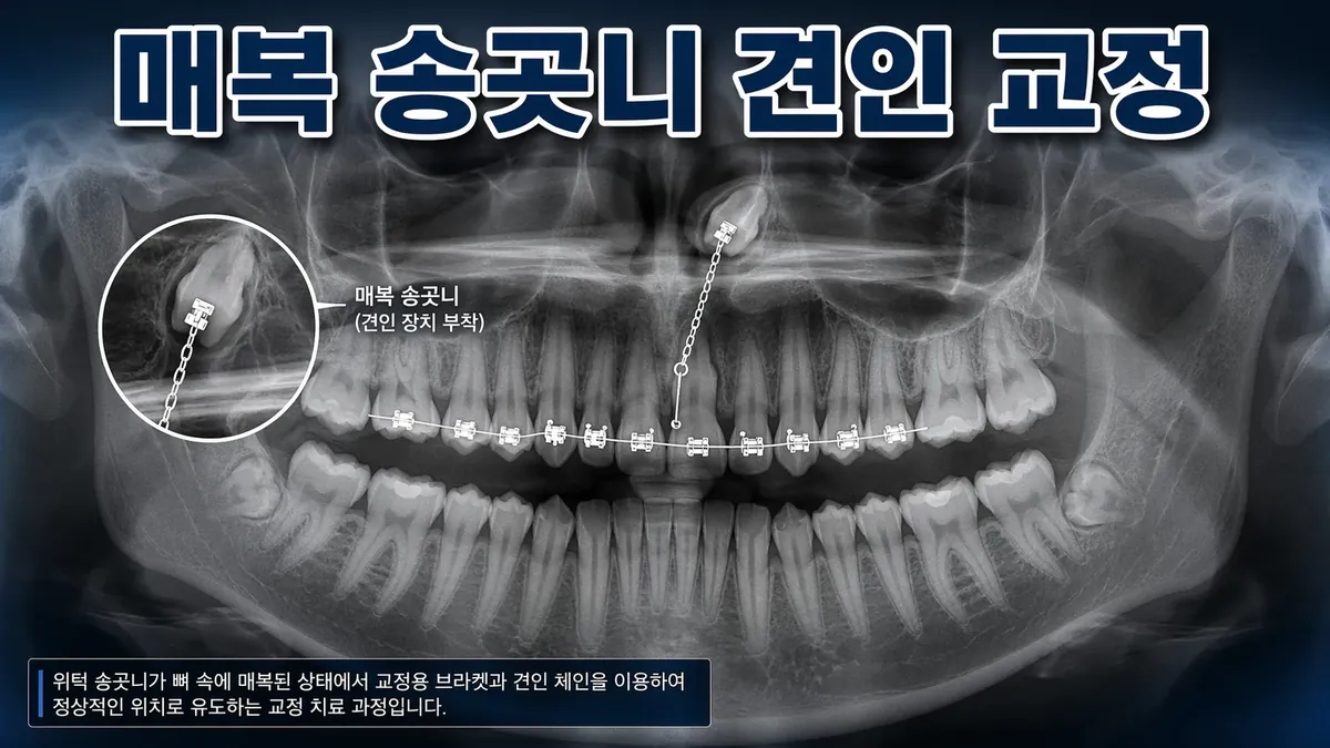 매복 송곳니, 뽑지 않고 끌어내리는 방법 | 교정전문의