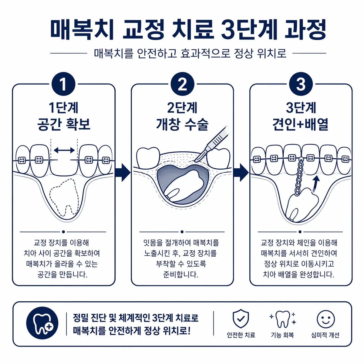 견인 3단계 과정