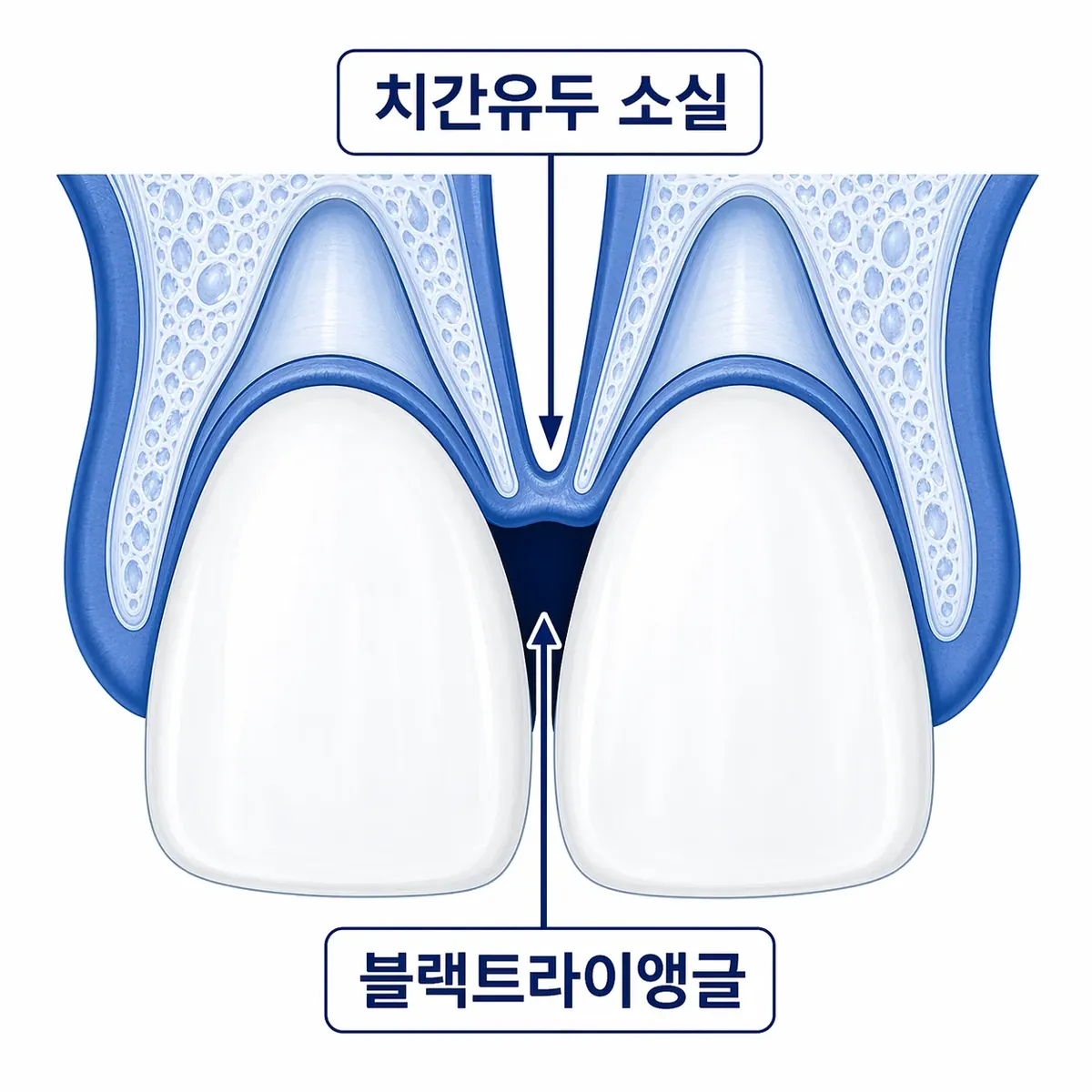 블랙트라이앵글 다이어그램
